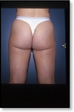 liposuzione_dopo