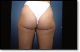 liposuzione_prima