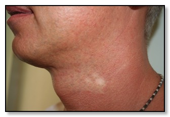 post endolift