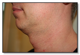pre endolift